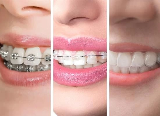 Braces or Aligners?